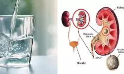 गर्मी के मौसम में बढ़ी पथरी के रोगियों की संख्या, क्या है कारण जानिये यहाँ