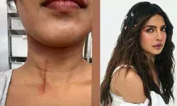 द ब्लफ के सेट पर बाल-बाल बचीं प्रियंका चोपड़ा, गले पर दिखा गहरा घाव