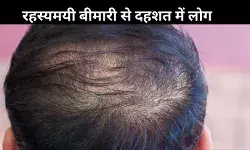 महाराष्ट्र: 3 गांवों में रहस्यमयी बीमारी ने मचाया कोहराम, सिर पर हाथ फेरते ही झड़ने लगे बाल