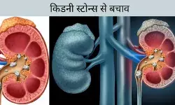 किडनी से जुड़ी बीमारियां और इनसे बचाव के उपाय, नहीं होगी स्टोन प्रॉब्लम