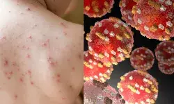 यूएस में बढ़ रहा खसरे का प्रकोप, सीडीसी ने कहा गलतफहमी के शिकार अमेरिकी!