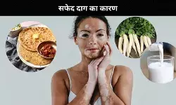 सफेद दागों से भर जाता है चेहरा, जो लोग नाश्ते में खाते हैं ये चीजें