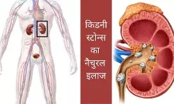 क्यों 50% लोग कराते हैं 3 से 5 साल में किडनी स्टोन्स का दोबारा ऑपरेशन?