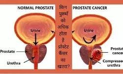 Prostate Cancer Causes