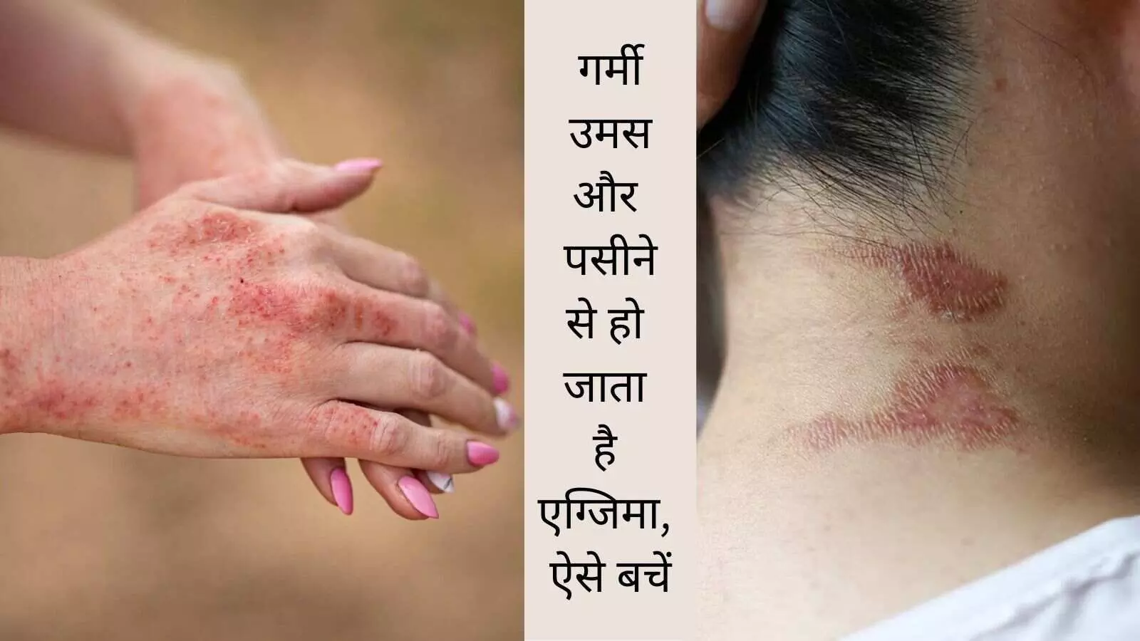 Eczema skin disease in humidity Eczema skin disease in humidity