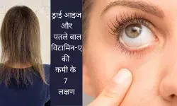Vitamin A deficiency symptom thin hair dry eyes