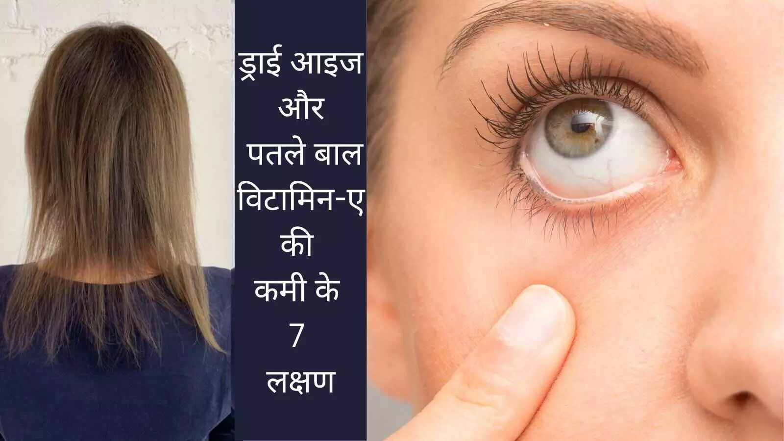 Vitamin A deficiency symptom thin hair dry eyes Vitamin A deficiency symptom thin hair dry eyes