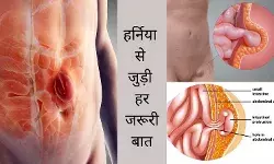 Hernia causes hernia treatment symptoms care prevention