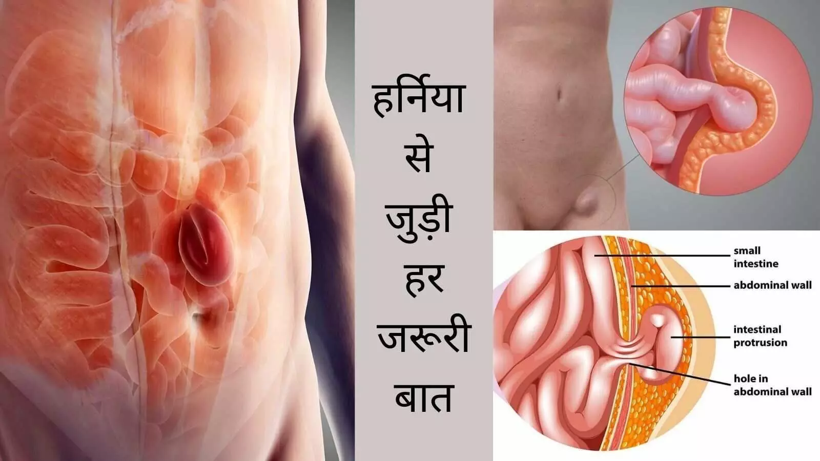Hernia causes hernia treatment symptoms care prevention Hernia causes hernia treatment symptoms care prevention