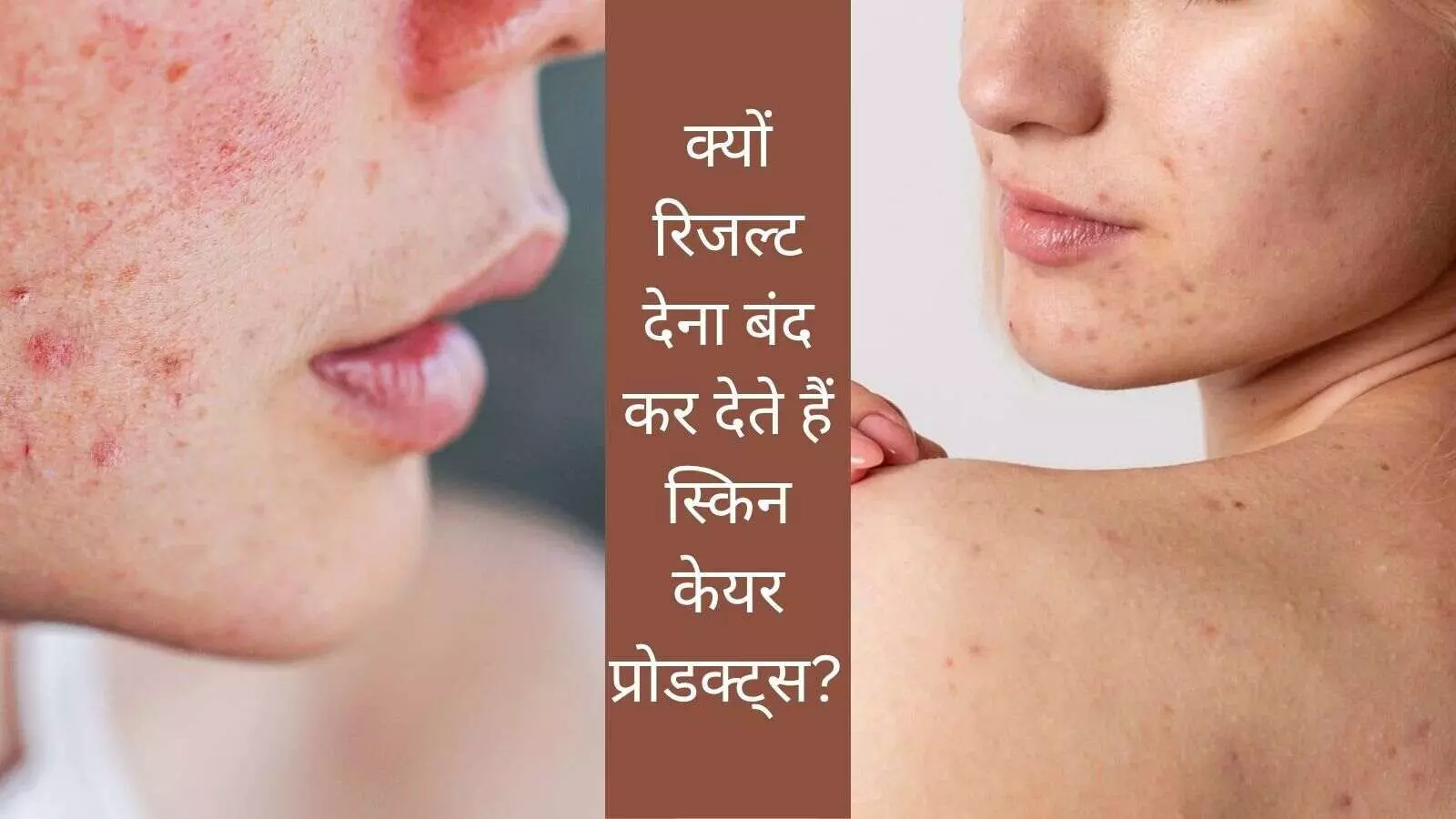 Beauty Products Skin Care Products Acne Causes Beauty Products Skin Care Products Acne Causes
