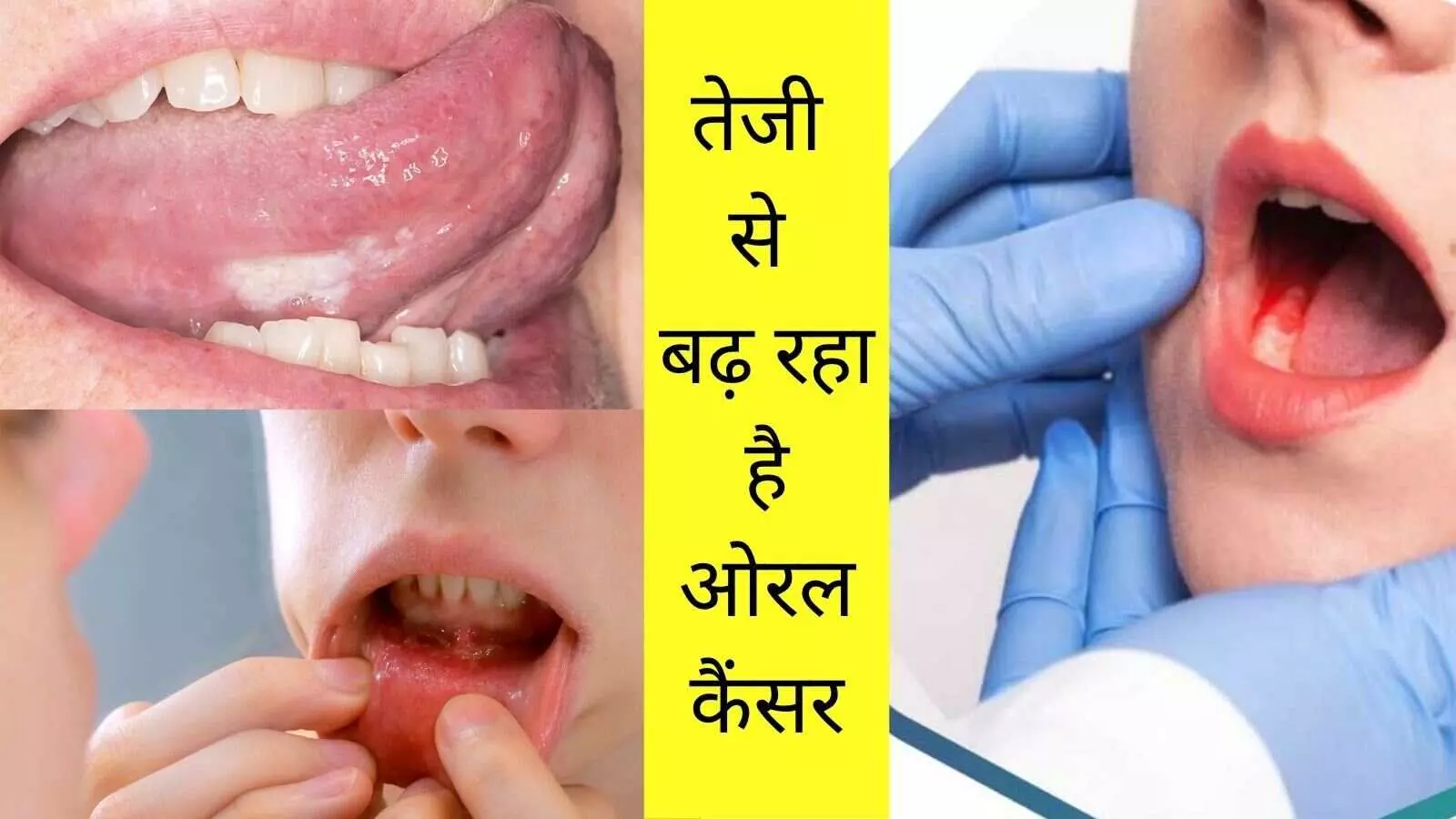Oral cancer in India Tobacco use statistics Smokeless tobacco effects Gutka and cancer link India cancer survival rate Oral cancer in India Tobacco use statistics Smokeless tobacco effects Gutka and cancer link India cancer survival rate