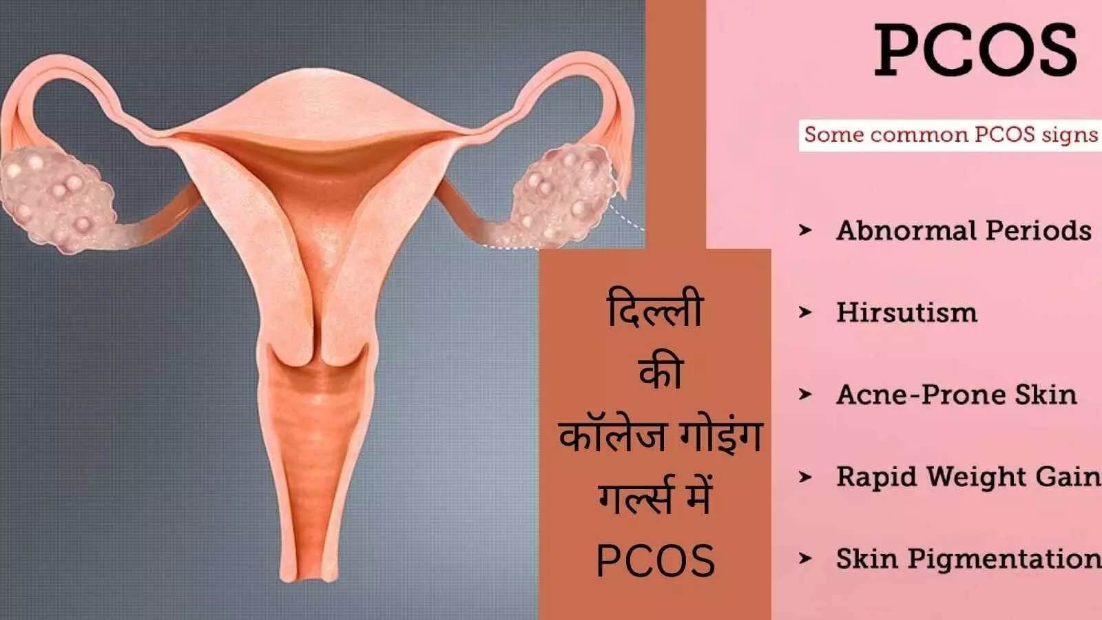 PCOS and obesity Urban lifestyle and PCOS