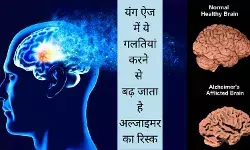 brain shrinkage active lifestyle dementia prevention Alzheimer disease