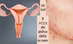 PCOS skin problems Hormonal acne PCOS PCOS and hair loss PCOS facial hair PCOS acne treatment