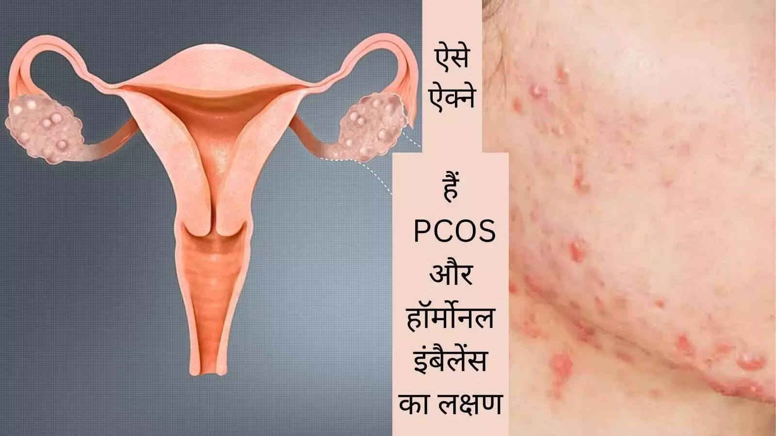 PCOS skin problems Hormonal acne PCOS PCOS and hair loss PCOS facial hair PCOS acne treatment PCOS skin problems Hormonal acne PCOS PCOS and hair loss PCOS facial hair PCOS acne treatment