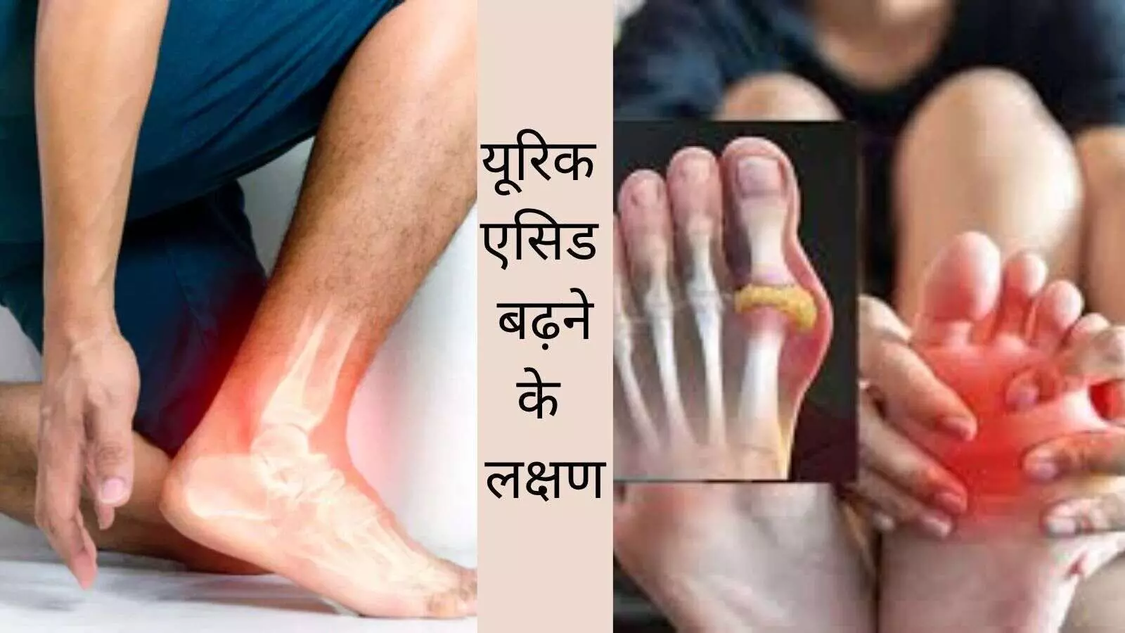 Uric acid symptoms What is uric acid Normal range of uric acid Uric acid blood report Uric acid symptoms What is uric acid Normal range of uric acid Uric acid blood report