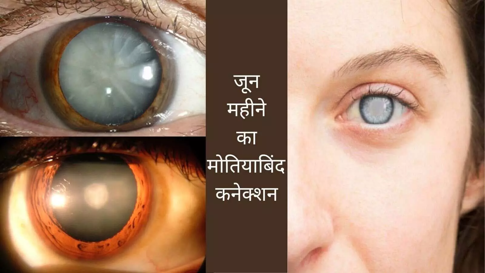Artificial Eye Lens, UV Protection Glasses, Diabetes and Cataract Age-related Cataract Eye Care After 40 Eye Health Tips Vision Loss Prevention Early Cataract Detection Cataract Complications Artificial Eye Lens, UV Protection Glasses, Diabetes and Cataract Age-related Cataract Eye Care After 40 Eye Health Tips Vision Loss Prevention Early Cataract Detection Cataract Complications