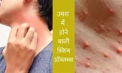 skin problems in humidity fungal infection treatment heat rash in monsoon