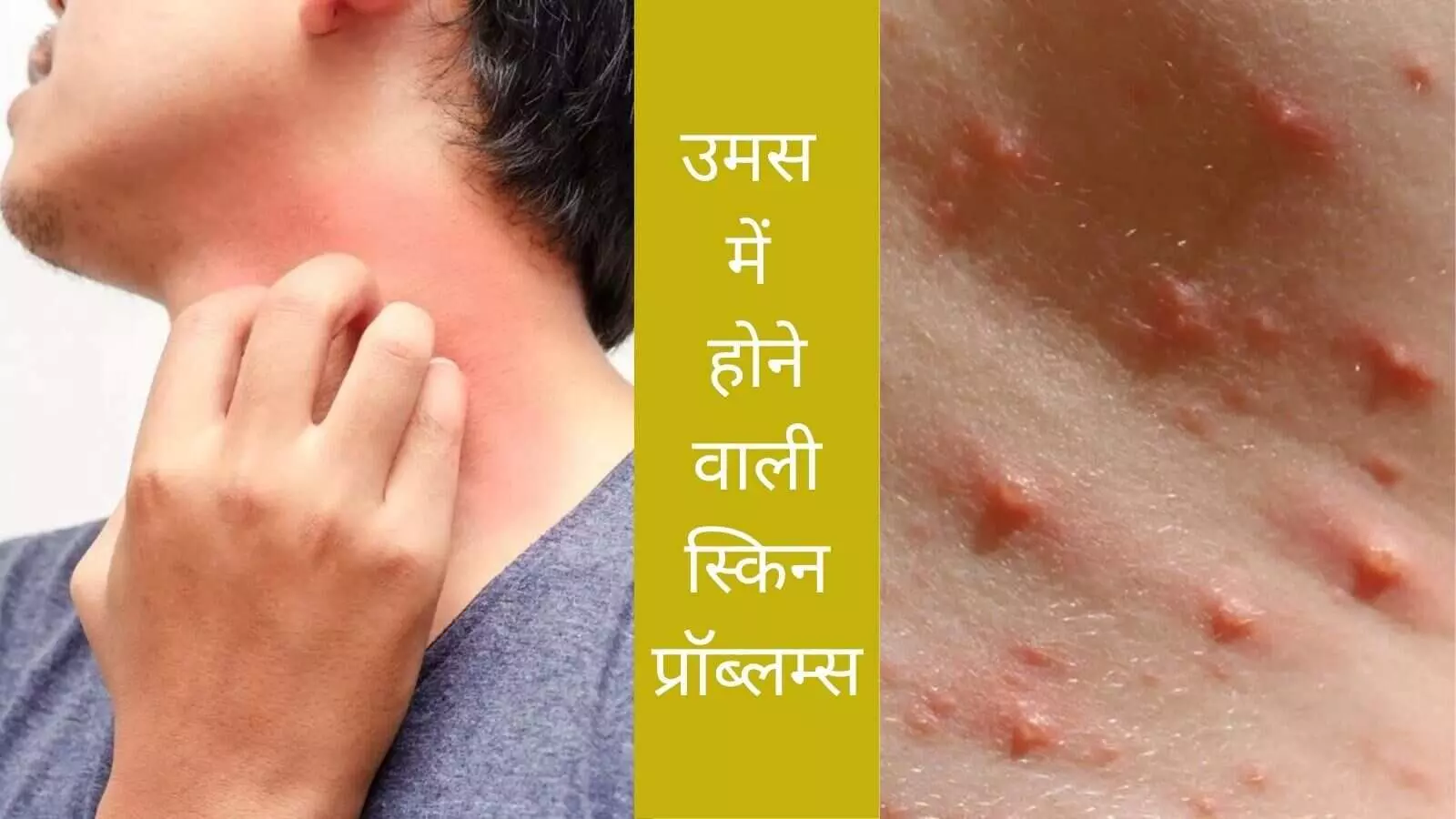 skin problems in humidity fungal infection treatment heat rash in monsoon