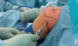 कई प्रयासों के बाद मिला सटीक इलाज, ‘रोटेटर कफ रिपेयर’ सर्जरी से महिला को राहत