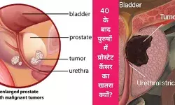 Prostate cancer causes prevention and treatment