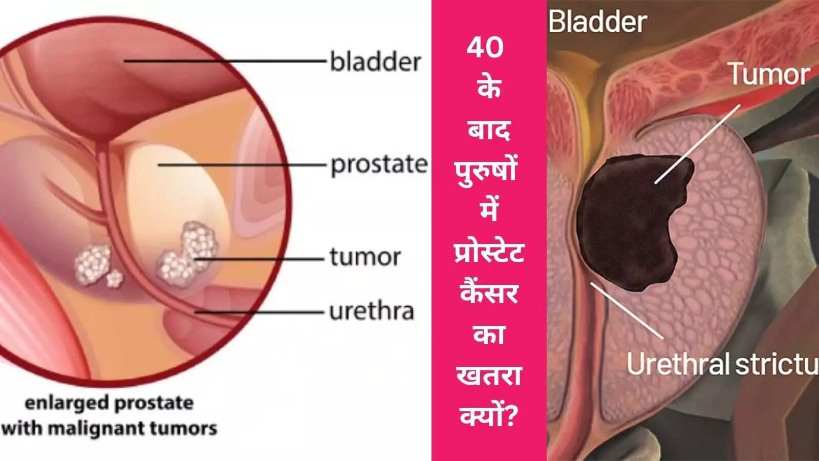Prostate cancer causes prevention and treatment