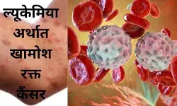 Leukemia, Blood cancer, Bone marrow, White blood cells, Acute Lymphoblastic Leukemia, Childhood leukemia, Leukemia symptoms, CAR-T cell therapy,