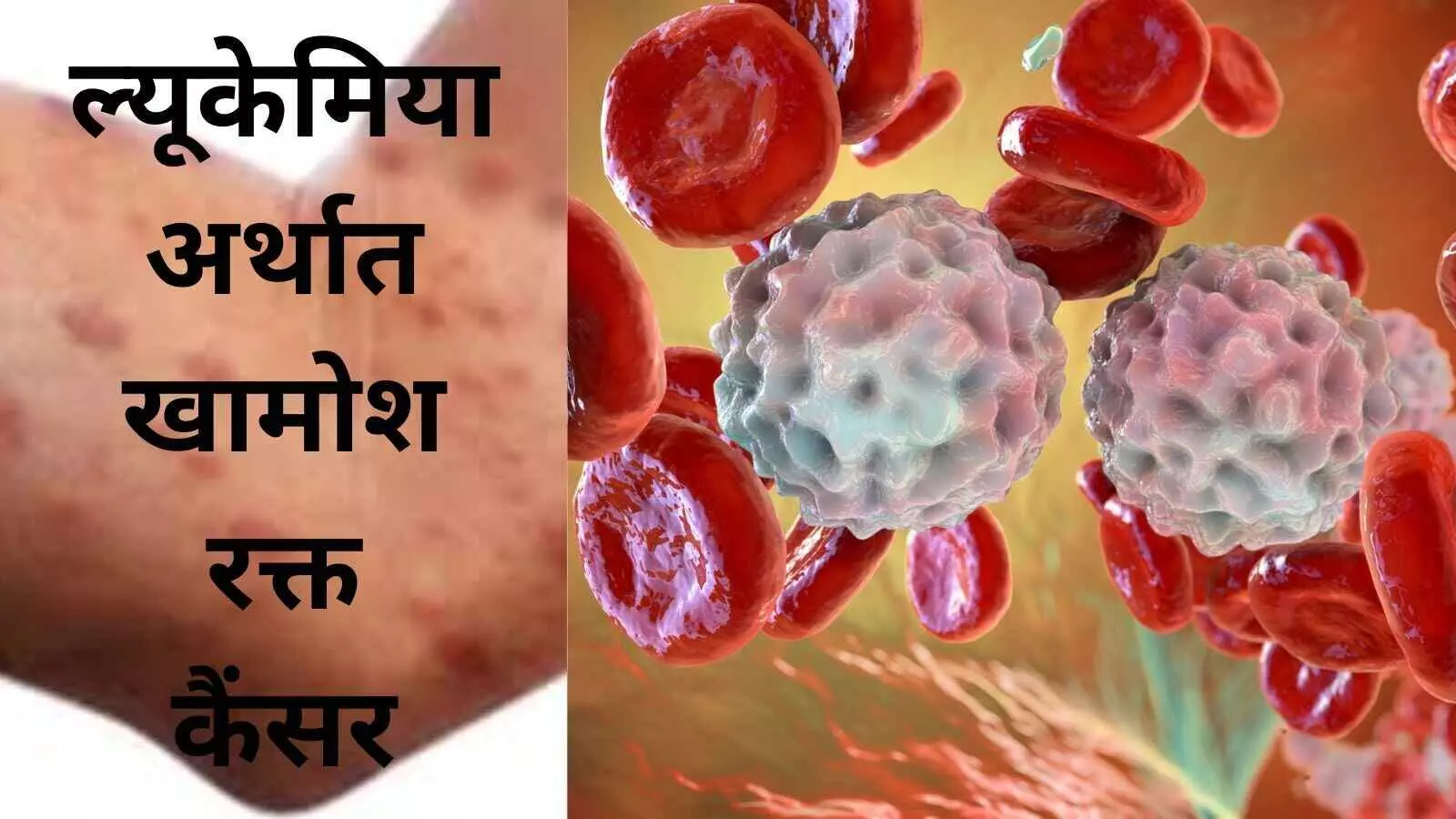 Leukemia, Blood cancer, Bone marrow, White blood cells, Acute Lymphoblastic Leukemia, Childhood leukemia, Leukemia symptoms, CAR-T cell therapy,