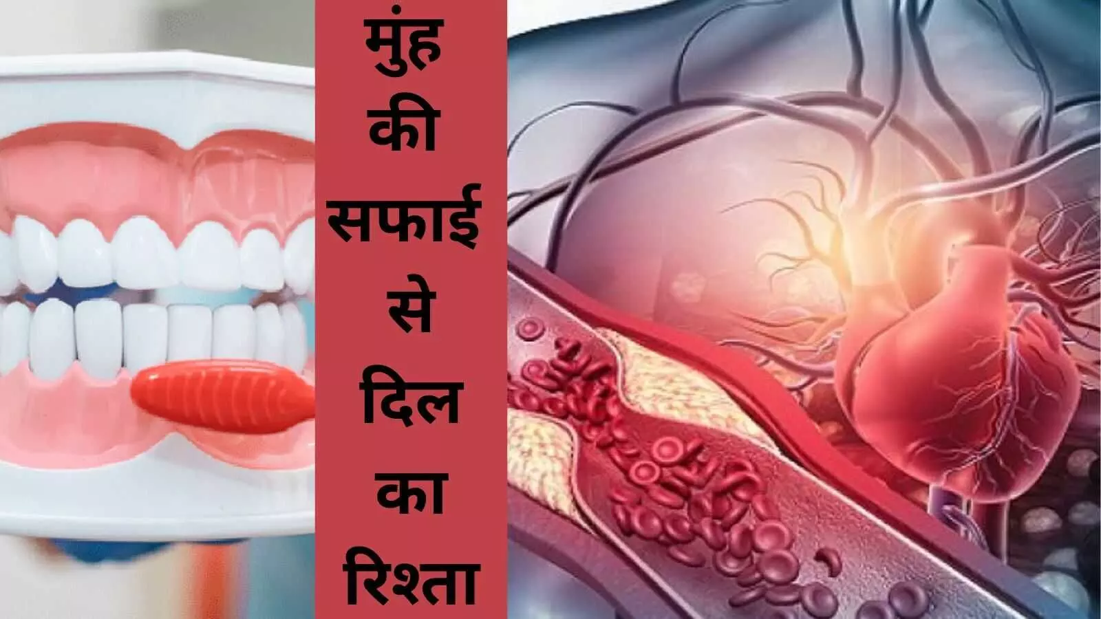 Heart attack Cholesterol Oral hygiene Bacteria Heart attack Cholesterol Oral hygiene Bacteria