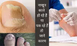 Nail infection Nail fungus Onychomycosis Gut health and nails Recurrent nail infection Weak nails Nail care Causes of fungal infection Foot hygiene