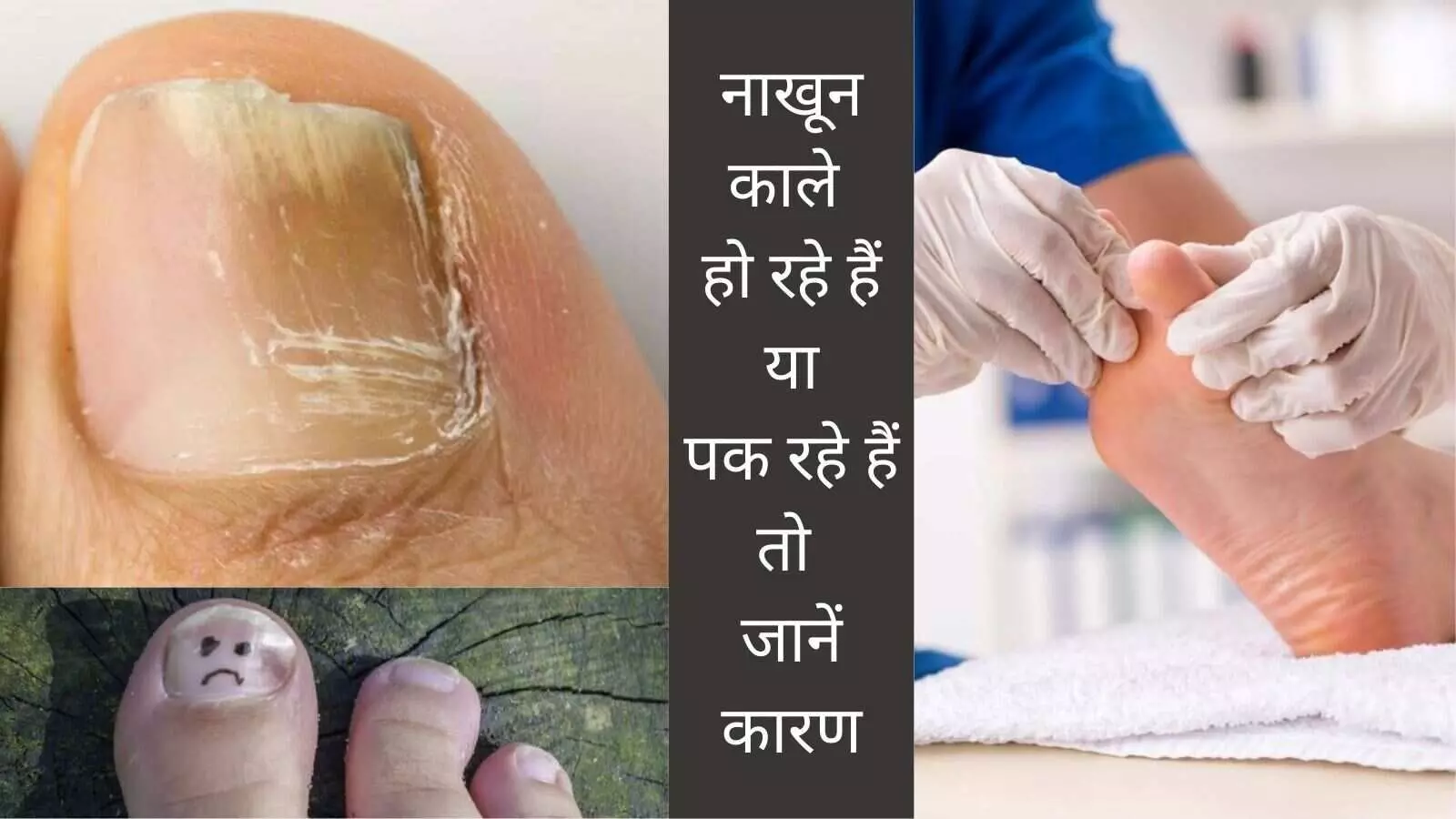 Nail infection Nail fungus Onychomycosis Gut health and nails Recurrent nail infection Weak nails Nail care Causes of fungal infection Foot hygiene