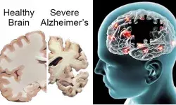 Alzheimer dementia memory loss cognitive health