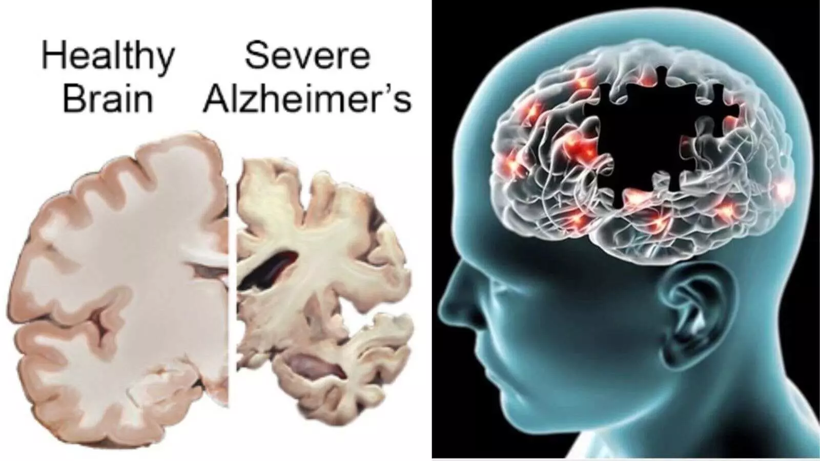 Alzheimer dementia memory loss cognitive health