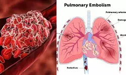 फेफड़ों के संक्रमण में जान बचाता है रक्त का थक्का, शोध ने दी नई दिशा
