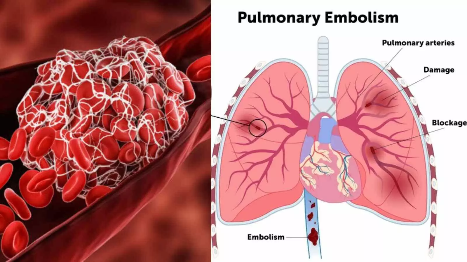 फेफड़ों के संक्रमण में जान बचाता है रक्त का थक्का, शोध ने दी नई दिशा फेफड़ों के संक्रमण में जान बचाता है रक्त का थक्का, शोध ने दी नई दिशा