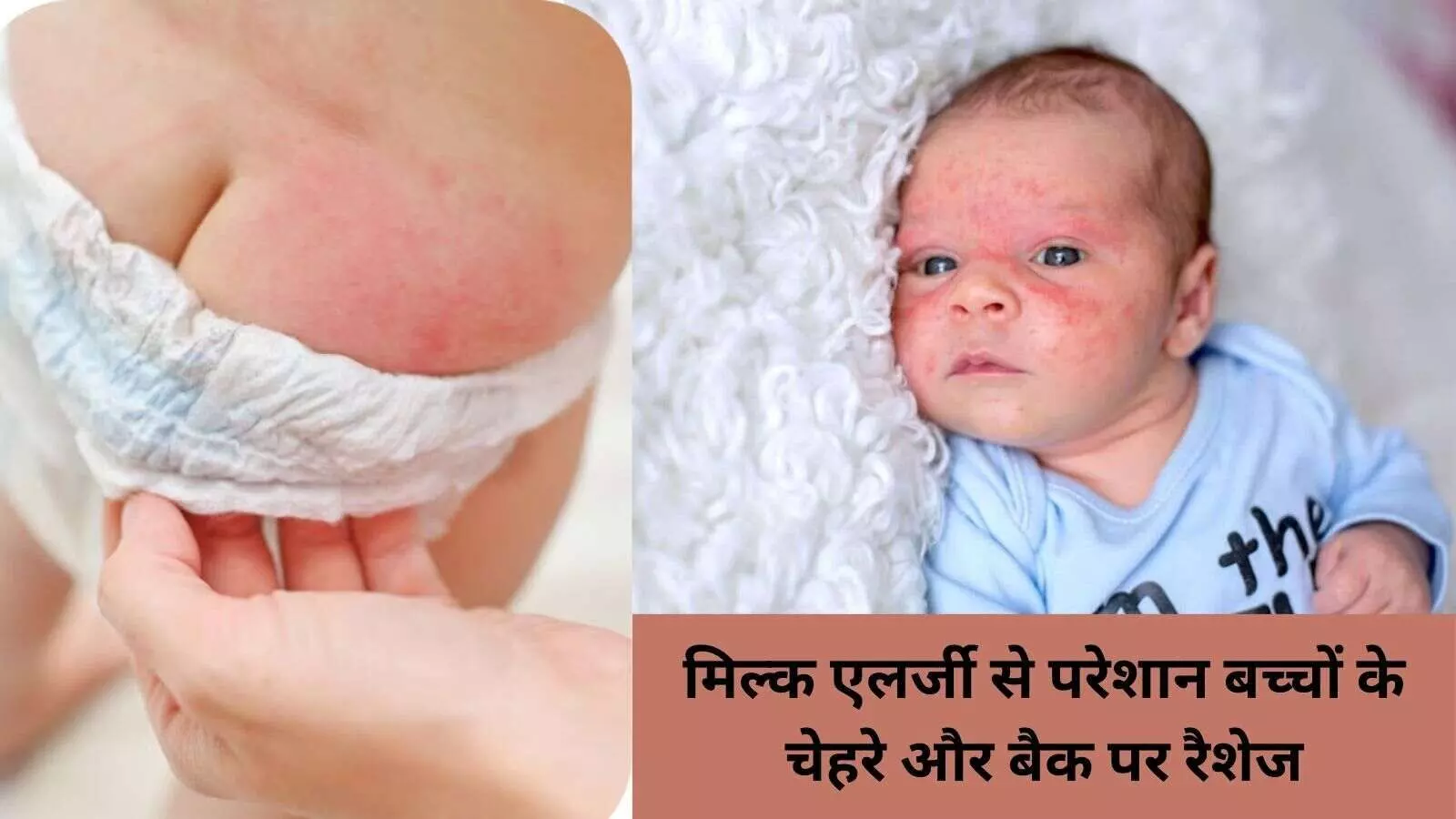 मिल्क एलर्जी से परेशान बच्चों के लिए वैज्ञानिकों का आसान समाधन मिल्क एलर्जी से परेशान बच्चों के लिए वैज्ञानिकों का आसान समाधन