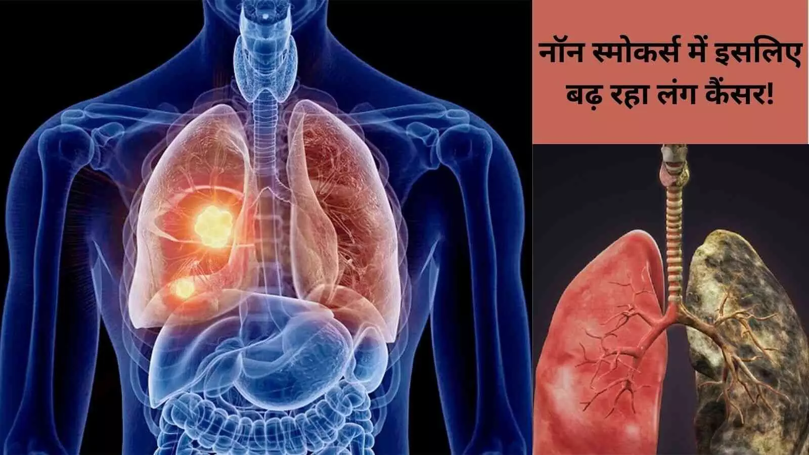 सैकेंड-हैंड कारणों से बढ़ रहा है फेफड़ों का कैंसर, जागरूकता से बचाव