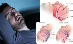 खर्राटे और स्लीप एपनिया बढ़ाते हैं डिमेंशिया का खतरा, ना करें अनदेखी