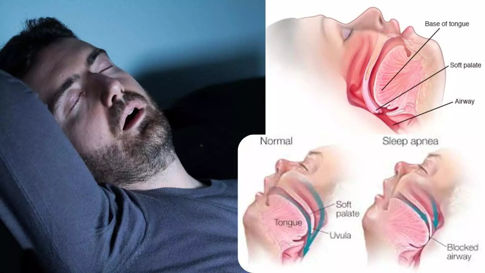 खर्राटे और स्लीप एपनिया बढ़ाते हैं डिमेंशिया का खतरा, ना करें अनदेखी खर्राटे और स्लीप एपनिया बढ़ाते हैं डिमेंशिया का खतरा, ना करें अनदेखी