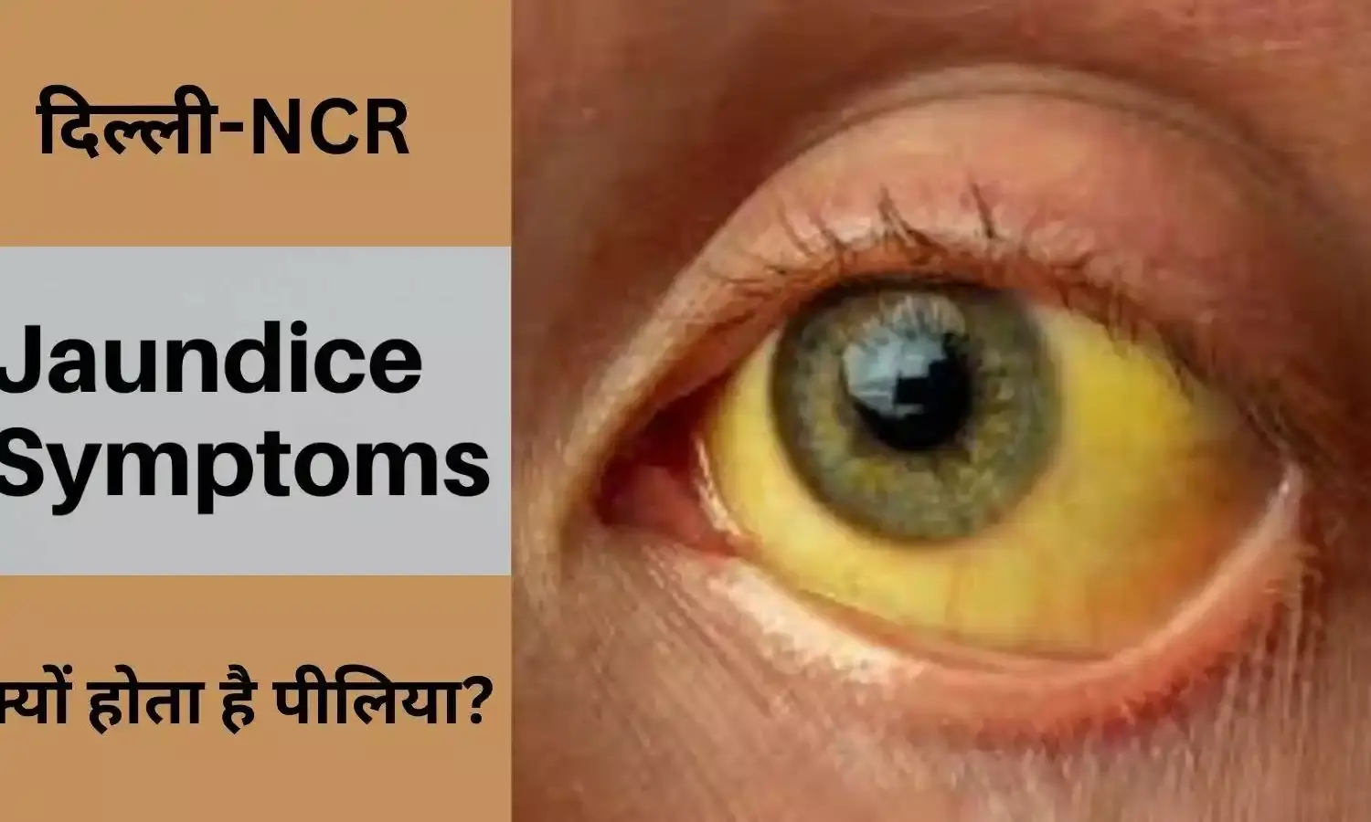 दिल्ली-NCR में मौसमी बीमारी से बड़ी समस्या है पीलिया,अनदेखी मुख्य कारण
