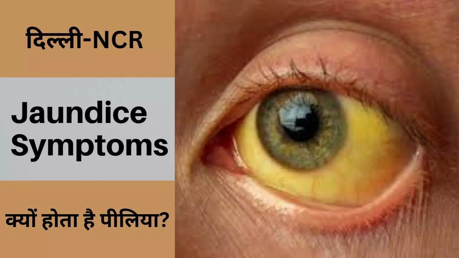 दिल्ली-NCR में मौसमी बीमारी से बड़ी समस्या है पीलिया,अनदेखी मुख्य कारण