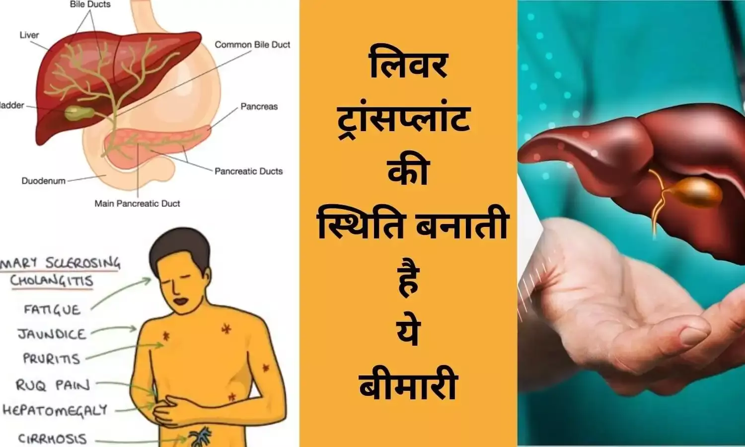 लिवर ट्रांसप्लांट से मिलेगी मुक्ति, संभव होगा ‘दुर्लभ’ बीमारी का इलाज