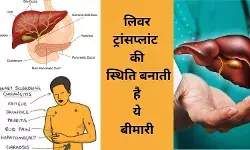 लिवर ट्रांसप्लांट से मिलेगी मुक्ति, संभव होगा ‘दुर्लभ’ बीमारी का इलाज