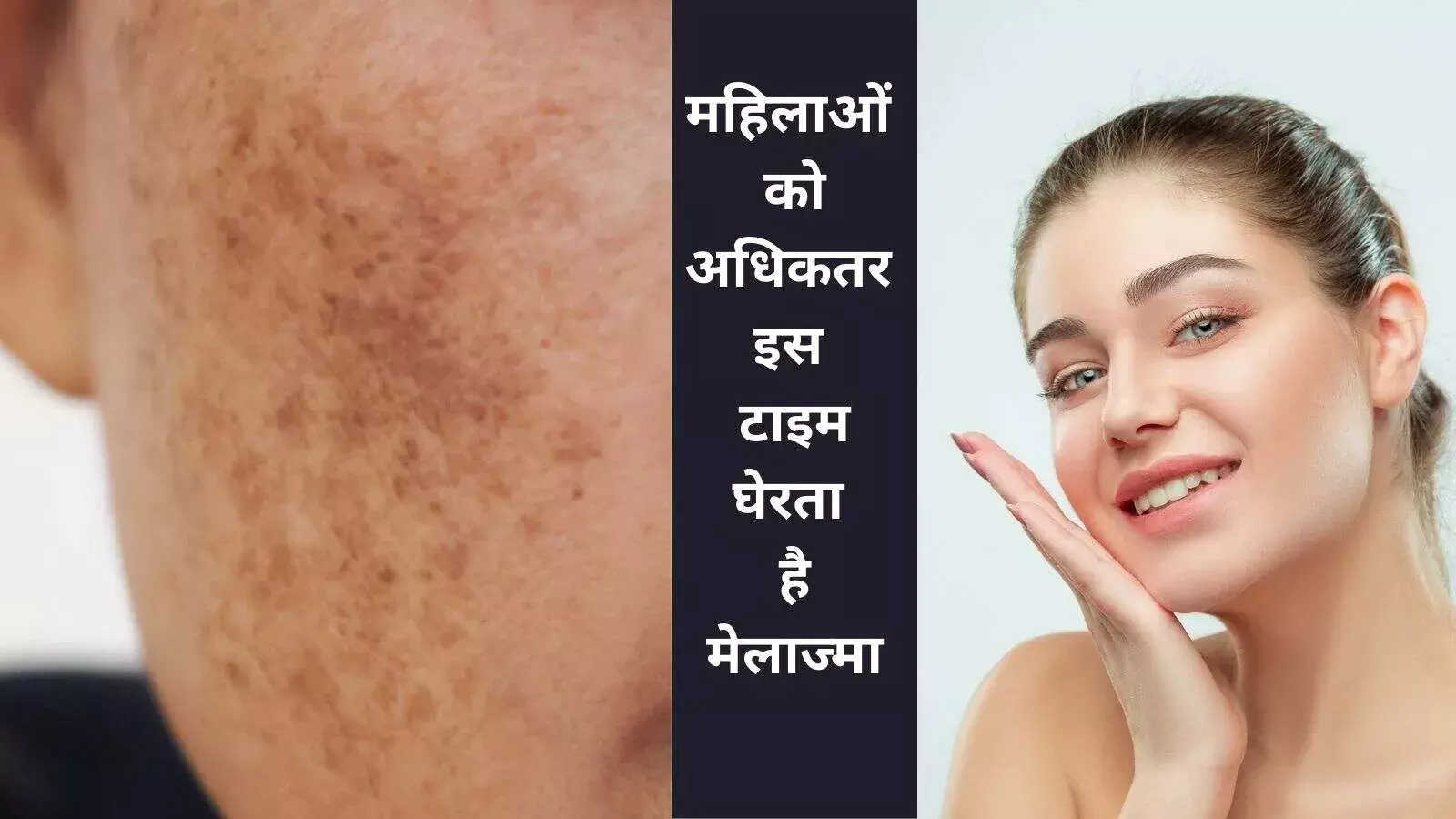 मेलाज्मा हॉर्मोन्स की समस्या है, चेहरे पर उभरे दागों को ना करें अनदेखा