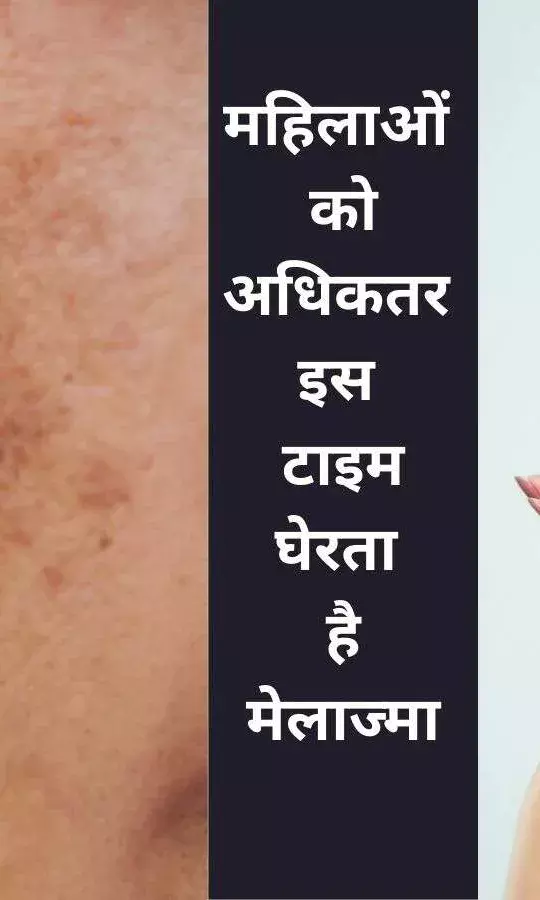 मेलाज्मा हॉर्मोन्स की समस्या है, चेहरे पर उभरे दागों को ना करें अनदेखा